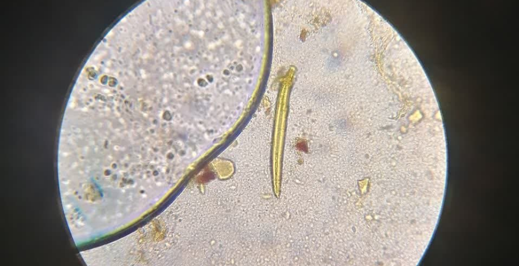 لارو کرمک (Pinworm) در نمونه یک کودک 5 ساله